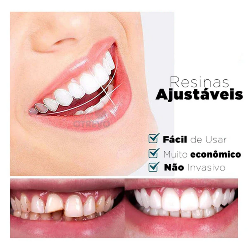 SmileFit® - Facetas Dentárias Naturais Removíveis