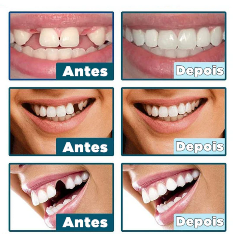 SmileFit® - Facetas Dentárias Naturais Removíveis